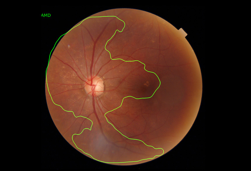 닥터눈 Fundus