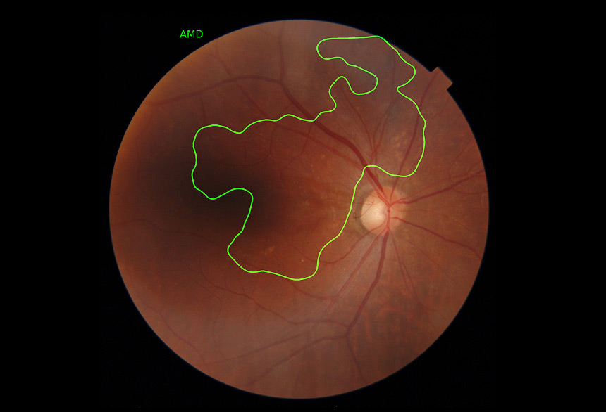 닥터눈 Fundus