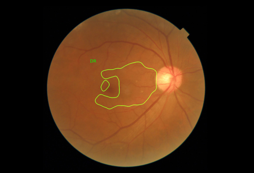 닥터눈 Fundus